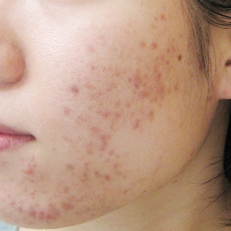 ニキビ治療のビフォーアフター