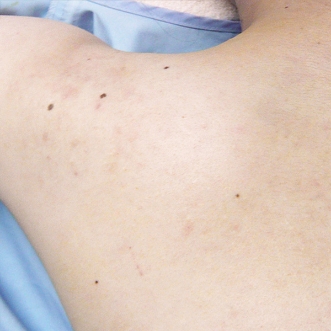 ニキビ治療のビフォーアフター