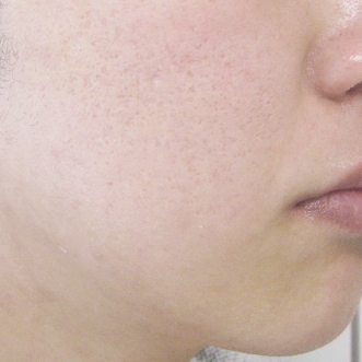 ニキビ治療のビフォーアフター