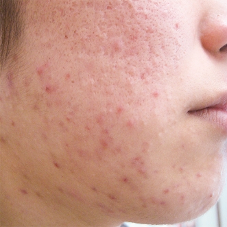 ニキビ治療のビフォーアフター