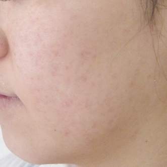 ニキビ治療のビフォーアフター