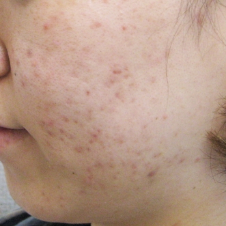 ニキビ治療のビフォーアフター