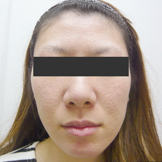 ニキビ治療のビフォーアフター