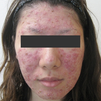 ニキビ治療のビフォーアフター