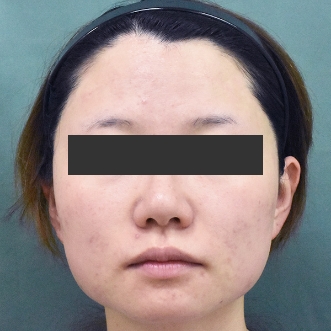 ニキビ治療のビフォーアフター