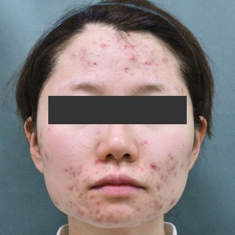 ニキビ治療のビフォーアフター