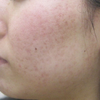 ニキビ治療のビフォーアフター