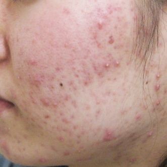 ニキビ治療のビフォーアフター