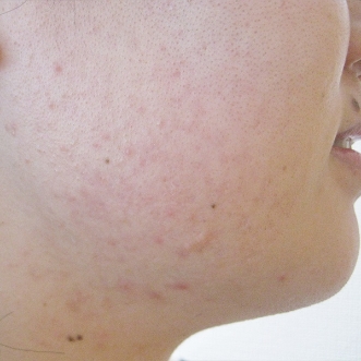 ニキビ治療のビフォーアフター