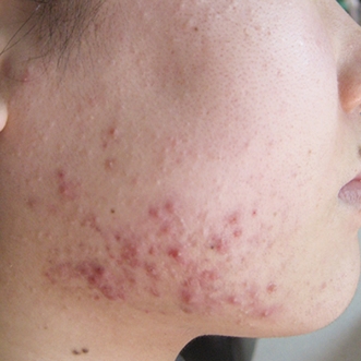 ニキビ治療のビフォーアフター