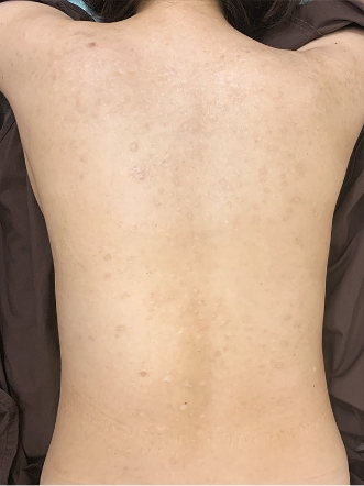 ニキビ治療のビフォーアフター