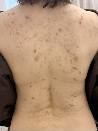 ニキビ治療のビフォーアフター