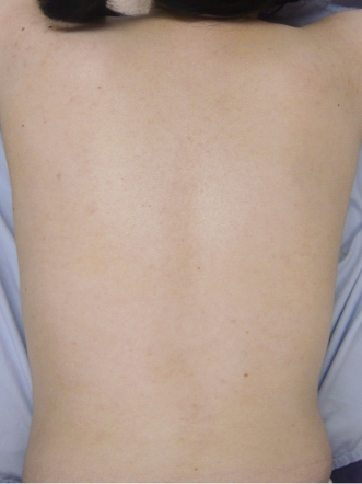 ニキビ治療のビフォーアフター