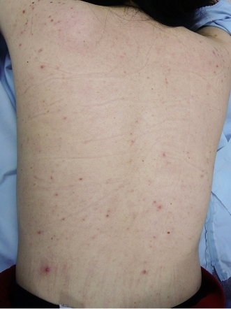 ニキビ治療のビフォーアフター