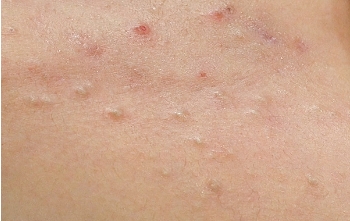 白ニキビ / 黒ニキビ