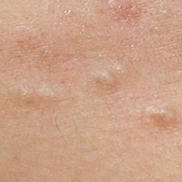 白ニキビ / 黒ニキビ