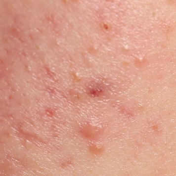 赤ニキビ（炎症性）