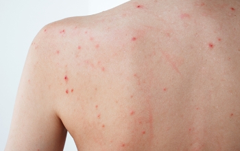 背中・デコルテのニキビ