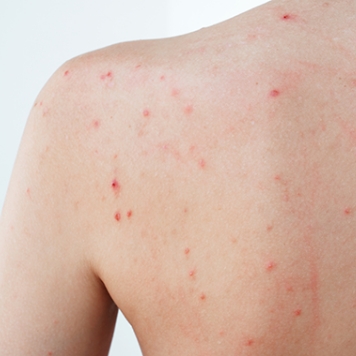 背中・デコルテのニキビ