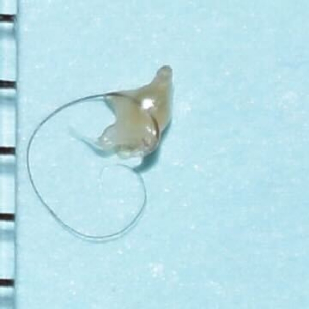 摘出したコメドno1