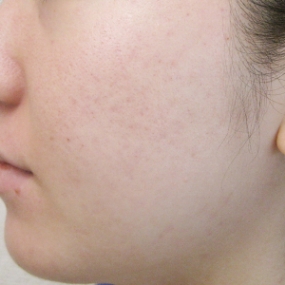 ニキビ治療のビフォーアフター