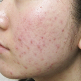 ニキビ治療のビフォーアフター