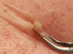 マイクロ排膿の写真