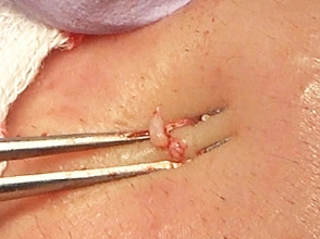 マイクロ排膿の写真