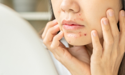 何年もニキビで悩んでいる人