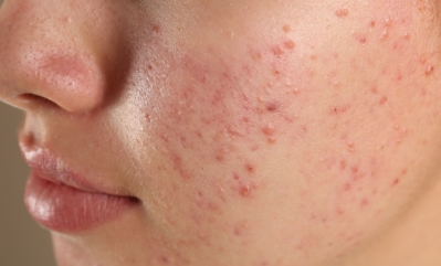 長期間抗菌薬を使用している方、なるべく内服を減らしたい人