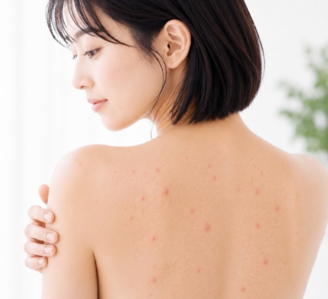 背中ニキビを繰り返している方